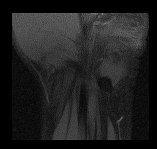 File:Central triangular fibrocartilage perforation (Radiopaedia 73346-84130 Coronal T1 fat sat 15).jpg