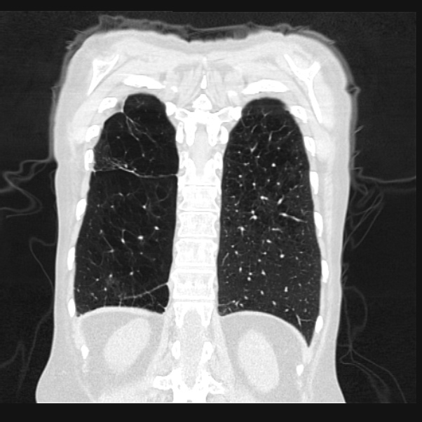 Centrilobular pulmonary emphysema (Radiopaedia 24495-24789 Coronal lung window 63).jpg
