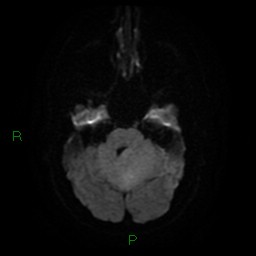 Cerebellar abscess (Radiopaedia 78135-90678 Axial DWI 10).jpg