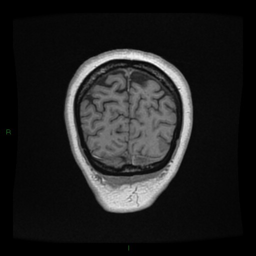 File:Cerebellar abscess (Radiopaedia 78135-90678 Coronal T1 C+ 150).jpg