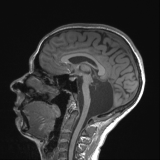 Cerebellar agenesis with hypoplastic pons (pontocerebellar hypoplasia) (Radiopaedia 57224-64138 Sagittal T1 35).png