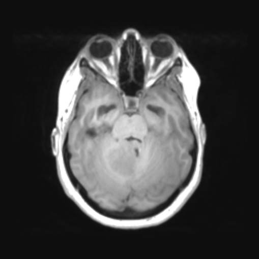 File:Cerebellar ependymoma complicated by post-operative subdural hematoma (Radiopaedia 83322-97736 Axial T1 15).png