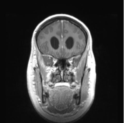 Cerebellar ependymoma complicated by post-operative subdural hematoma (Radiopaedia 83322-97736 Coronal T1 C+ 16).png