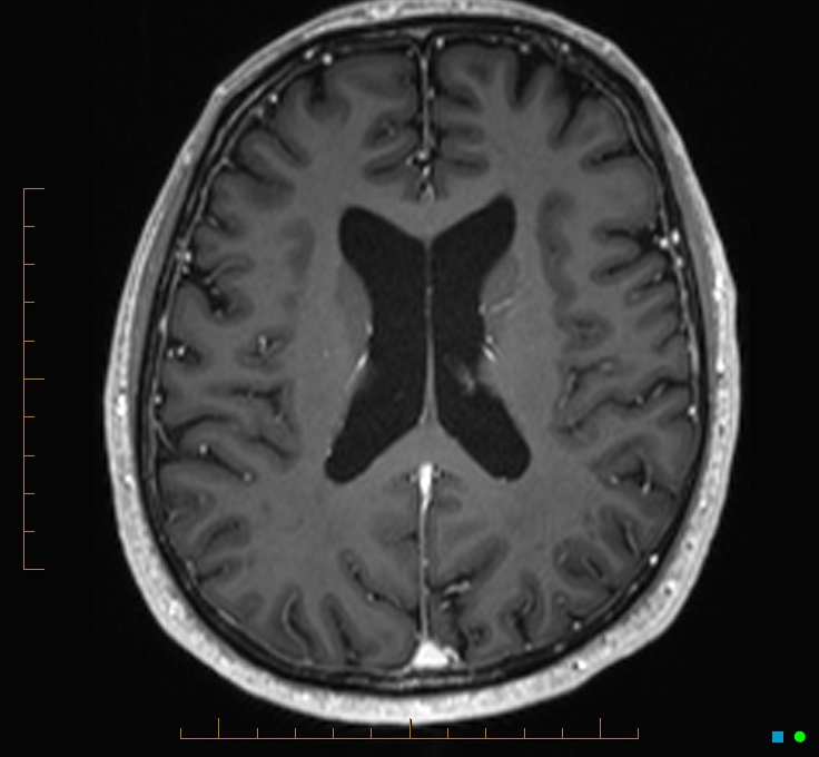 Cerebellar gangliocytoma (Radiopaedia 65377-74422 Axial T1 C+ 81).jpg