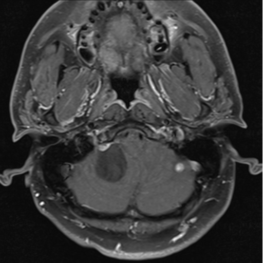 File:Cerebellar hemangioblastomas and pituitary adenoma (Radiopaedia 85490-101176 Axial T1 C+ fat sat 6).png