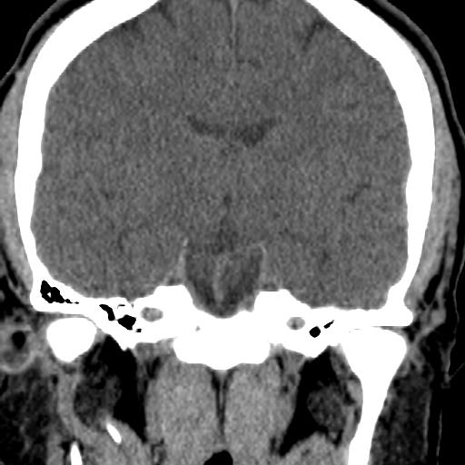 Cerebellar infarction (Radiopaedia 16625-16327 Coronal non-contrast 8).jpg