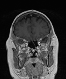File:Cerebellar metastasis (Radiopaedia 54578-60810 Coronal T1 C+ 10).png