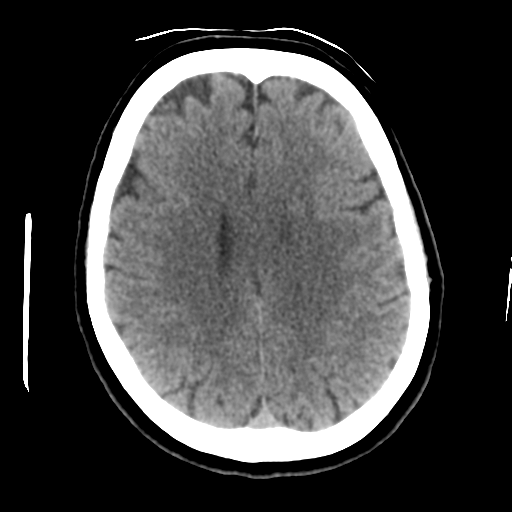 Cerebellar metastasis (cystic appearance) (Radiopaedia 41395-44258 Axial non-contrast 36).png