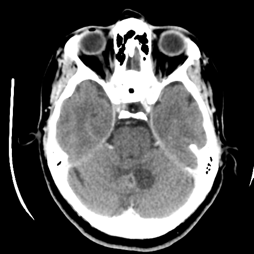 Cerebellar metastasis (cystic appearance) (Radiopaedia 41395-44258 B 17).png