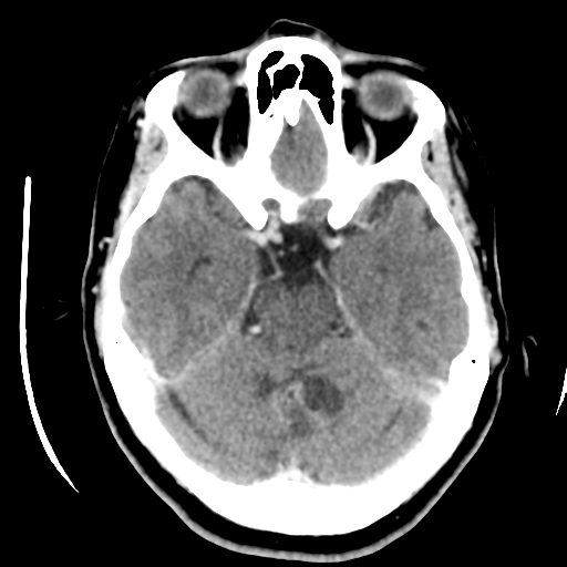 Cerebellar metastasis (cystic appearance) (Radiopaedia 41395-44258 B 18).png