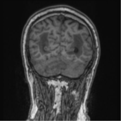 Cerebellar metastasis from lung adenocarcinoma (Radiopaedia 86690-102829 Coronal T1 23).png