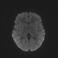 File:Cerebellar stroke (Radiopaedia 32202-33150 Axial DWI 35).png