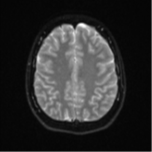 Cerebellar tuberculomas (Radiopaedia 46939-51472 Axial DWI 21).png