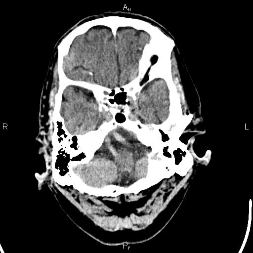 File:Cerebellopontine angle arachnoid cyst (Radiopaedia 85149-100704 Axial With contrast 7).jpg