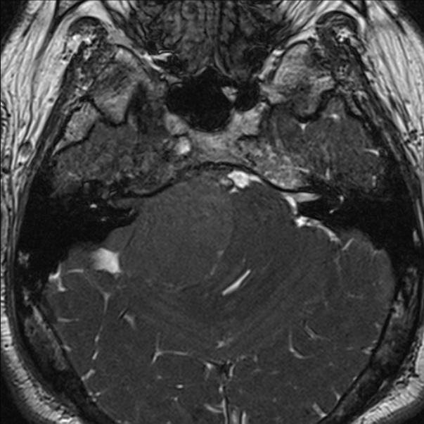 Cerebellopontine angle meningioma (Radiopaedia 24459-24764 I 25).jpg