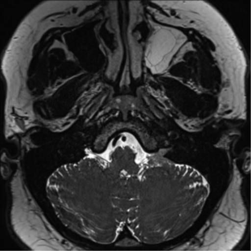 Cerebellopontine angle meningioma (Radiopaedia 48434-53348 Axial T2 Space 34).png