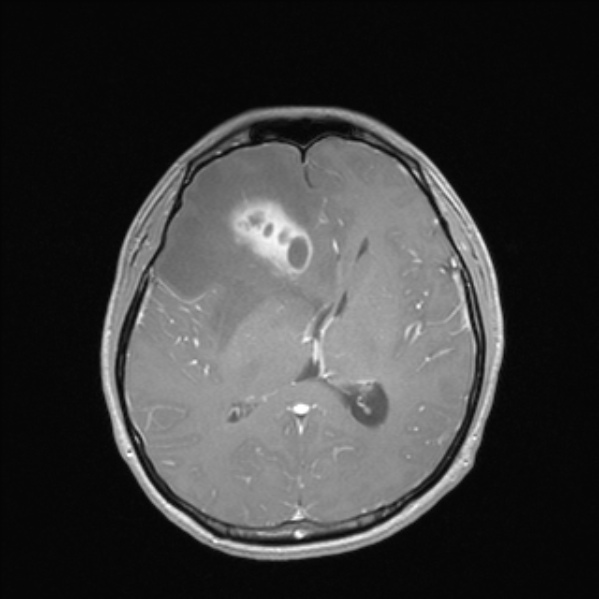 Cerebral abscess (Radiopaedia 24212-24478 Axial T1 C+ 34).jpg