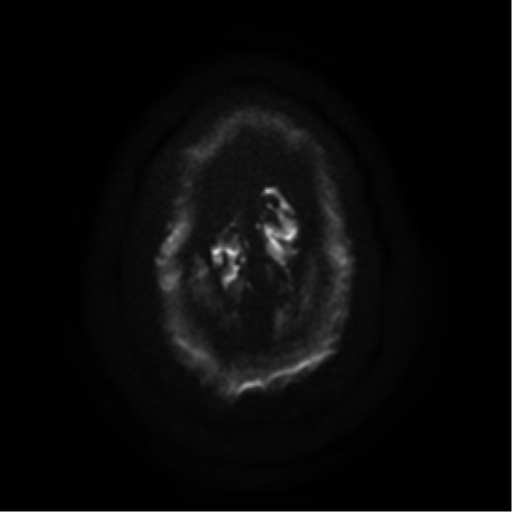 File:Cerebral abscess (Radiopaedia 57774-64740 Axial DWI 28).png
