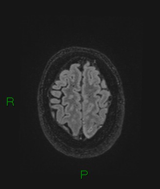 Cerebral abscess and subdural empyema (Radiopaedia 84436-99779 Axial FLAIR 17).jpg