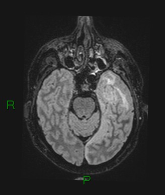 File:Cerebral abscess and subdural empyema (Radiopaedia 84436-99779 Axial FLAIR 57).jpg