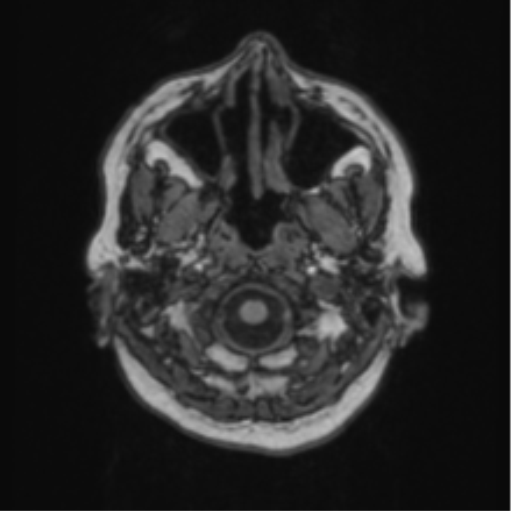 File:Cerebral abscess from pulmonary arteriovenous malformation (Radiopaedia 86275-102291 Axial T1 8).png