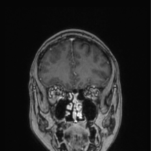 Cerebral abscess from pulmonary arteriovenous malformation (Radiopaedia 86275-102291 L 68).png