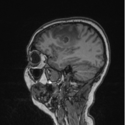 Cerebral abscess from pulmonary arteriovenous malformation (Radiopaedia 86275-102291 Sagittal T1 69).png