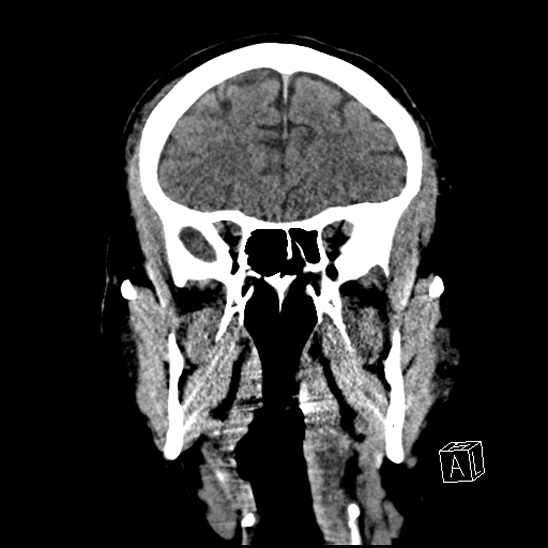 File:Cerebral abscess with ventriculitis (Radiopaedia 78965-91876 B 16).jpg