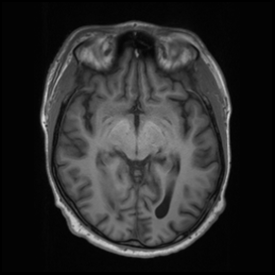 File:Cerebral abscess with ventriculitis (Radiopaedia 78965-91878 Axial T1 22).jpg