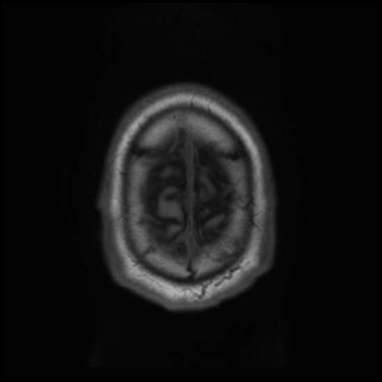 File:Cerebral abscess with ventriculitis (Radiopaedia 78965-91878 Axial T1 46).jpg
