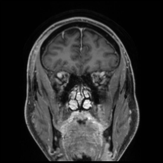 Cerebral abscess with ventriculitis (Radiopaedia 78965-91878 Coronal T1 C+ 18).jpg