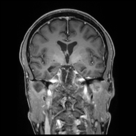 Cerebral abscess with ventriculitis (Radiopaedia 78965-91878 Coronal T1 C+ 31).jpg