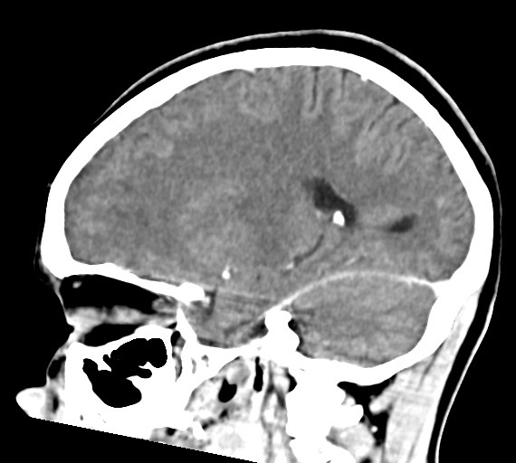 Cerebral abscesses (Radiopaedia 70458-80568 Sagittal Contrast 36).jpg