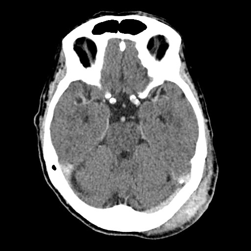 Cerebral amyloid angiopathy-related inflammation (Radiopaedia 74836-85848 Axial non-contrast 23).jpg