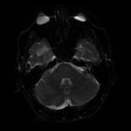 Cerebral amyloid angiopathy (Radiopaedia 28698-28978 Axial DWI 35).jpg