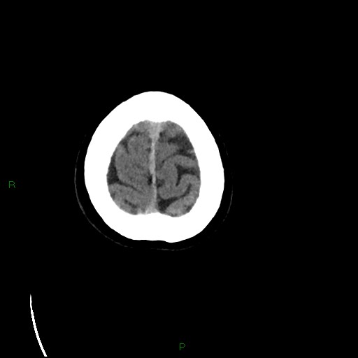 Cerebral amyloid angiopathy (Radiopaedia 77506-89665 Axial non-contrast 103).jpg