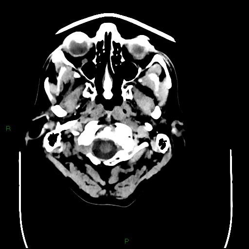 Cerebral amyloid angiopathy (Radiopaedia 77506-89665 Axial non-contrast 5).jpg