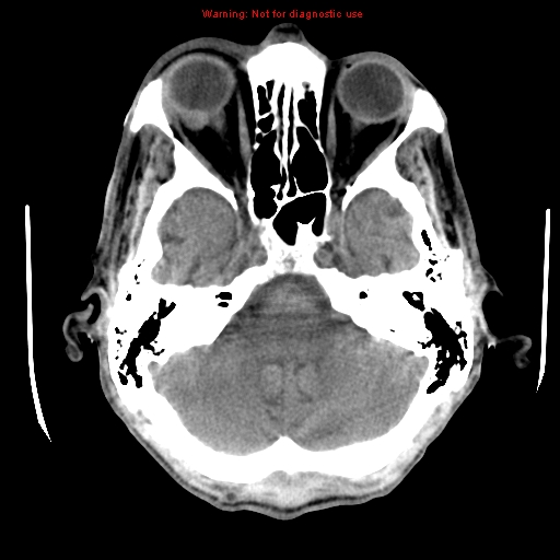 File:Cerebral and orbital tuberculomas (Radiopaedia 13308-13310 Axial non-contrast 7).jpg