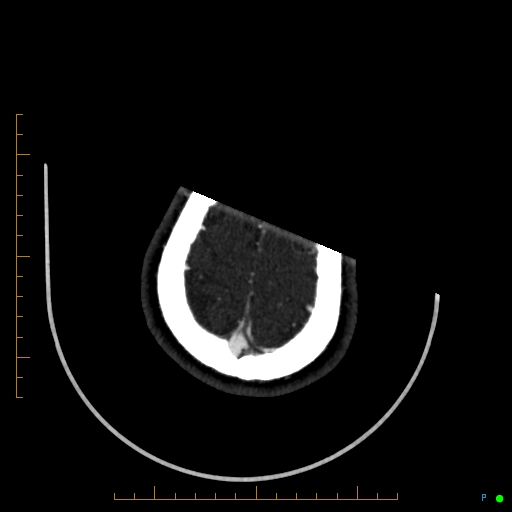 Cerebral arteriovenous malformation (AVM) (Radiopaedia 78162-90706 Axial CTA 243).jpg