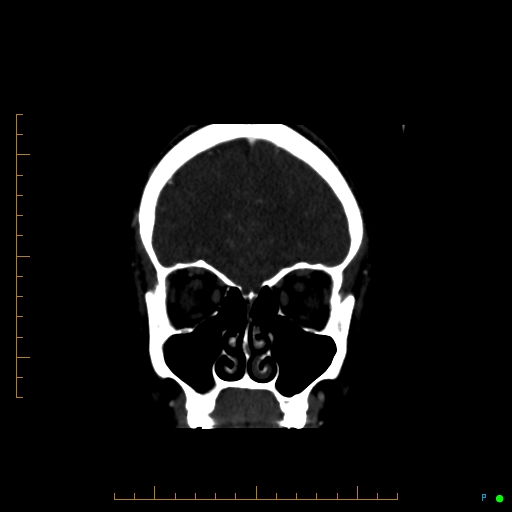 Cerebral arteriovenous malformation (AVM) (Radiopaedia 78162-90706 Coronal CTA 81).jpg
