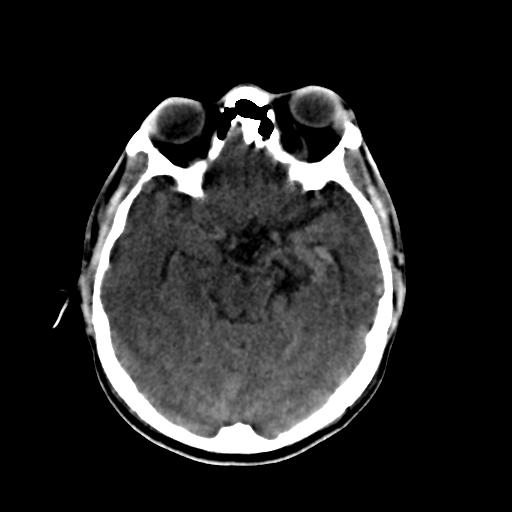 Cerebral arteriovenous malformation (Radiopaedia 28518-28759 Axial non-contrast 27).jpg