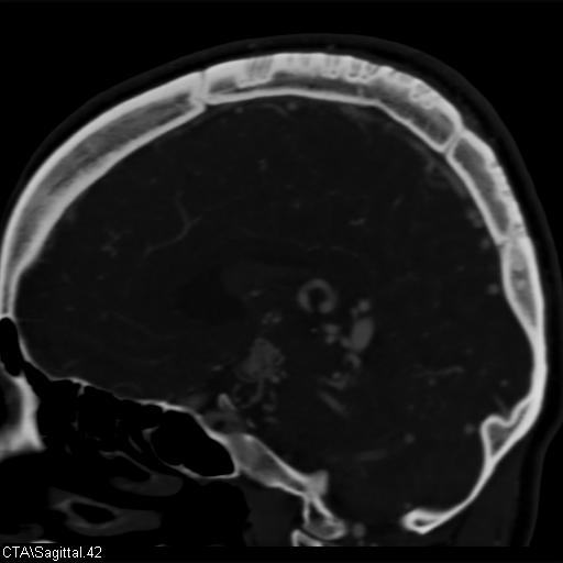Cerebral arteriovenous malformation (Radiopaedia 28518-28759 D 39).jpg