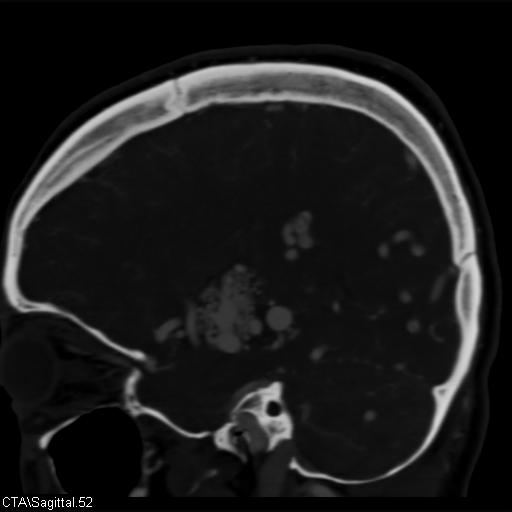 Cerebral arteriovenous malformation (Radiopaedia 28518-28759 D 49).jpg