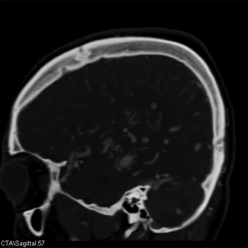 File:Cerebral arteriovenous malformation (Radiopaedia 28518-28759 D 54).jpg