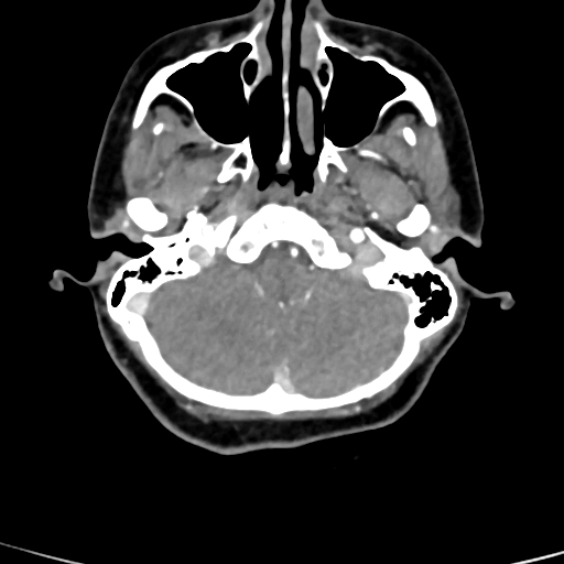 Cerebral arteriovenous malformation (Radiopaedia 73830-84645 B 83).jpg