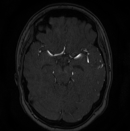Cerebral arteriovenous malformation (Radiopaedia 74411-85654 Axial MRA 49).jpg