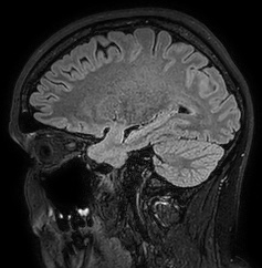 Cerebral arteriovenous malformation (Radiopaedia 74411-85654 Sagittal FLAIR 39).jpg