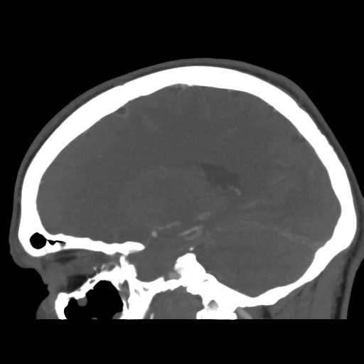 Cerebral arteriovenous malformation (Spetzler-Martin grade 2) (Radiopaedia 41262-44076 G 34).png