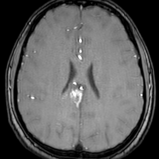 Cerebral arteriovenous malformation at posterior body of corpus callosum (Radiopaedia 74111-84925 Axial MRA 141).jpg