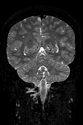 Cerebral arteriovenous malformation at posterior body of corpus callosum (Radiopaedia 74111-84925 Coronal T2 127).jpg